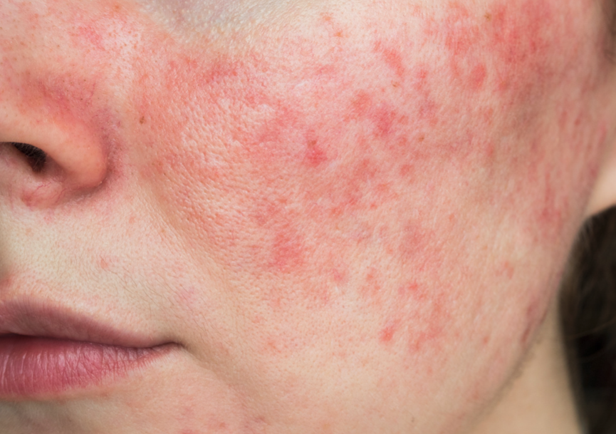 Rosacea (Acne)